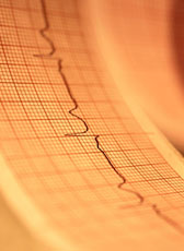 A photo of an EKG strip