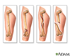 Ilustración de diversos tipos de fracturas