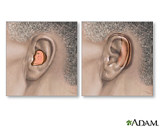Illustration of two types of hearing aids