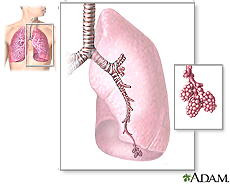 Ilustración de las principales estructuras de los pulmones que incluyen los bronquios, los bronquiolos y los alvéolos