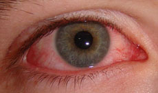 Un ojo con conjuntivitis