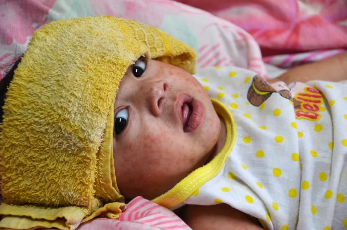 A tiny sick child lies on a bed and has a folded yellow towel wrapped around her head above her eyes.