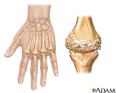 Illustration of rheumatoid arthritis
