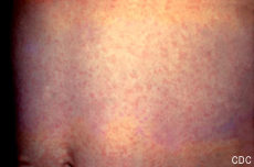 Photograph of an abdomen with a rash caused by rubella