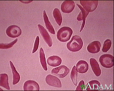 Micrografía de glóbulos rojos, incluyendo los drepanocíticos múltiples en forma de medialuna