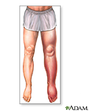 Ilustración de hinchazón en la pierna, tobillo y pie