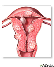 Illustration of uterine fibroids