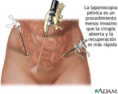 La laparoscopia pélvica