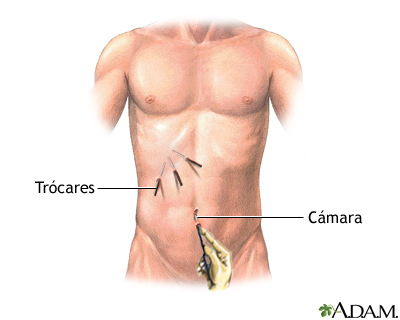 Ventajas de la cirugía por laparoscopía