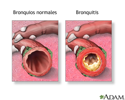 Bronquitis Aguda