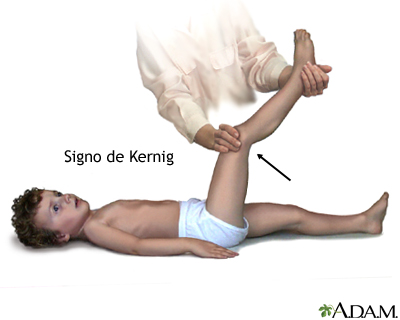 Signo de meningitis de Kernig