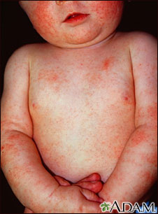 Dermatitis atópica en un bebé
