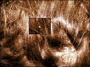 Piojos de la cabeza: primer plano de liendres en el cabello