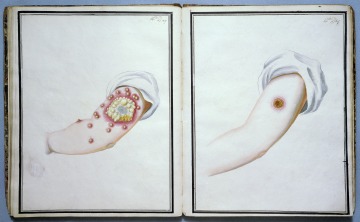 Watercolour drawings showing smallpox and cowpox vaccination, day 14th