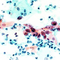 image of cervical cancer cells