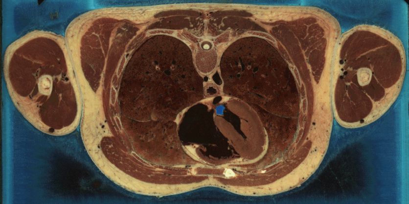 The Visible Human Project - Color Cryosections