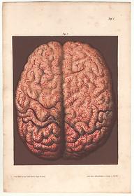 Brain hypostasis, 1864