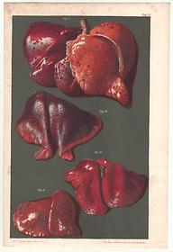 The color of the lungs of dead newborn children: stillborn, newborn who have taken a breath, newborn whose lungs have been artificially inflated, 1864