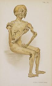 Mummified cadaver, sitting, 1898