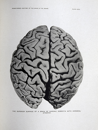 Plate 31: The superior surface of a brain of chronic dementia with cerebral atrophy – a photograph of the top exterior surface of a brain