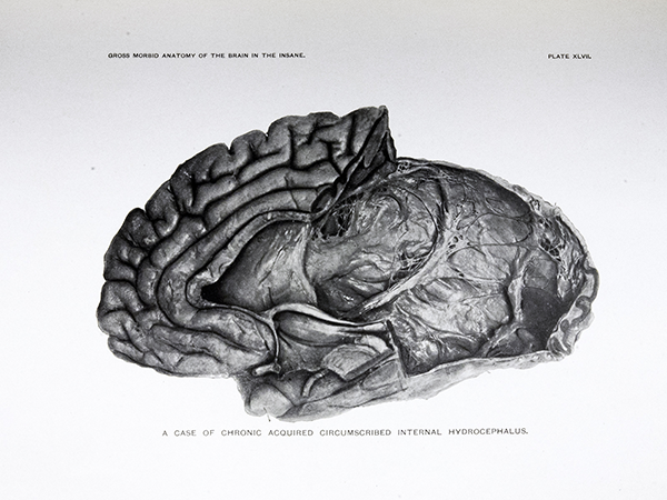 Plate 47: A case of chronic acquired circumscribed internal hydrocephalus – a photograph of a cross section of a brain from the side.